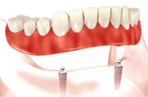 stud overdenture