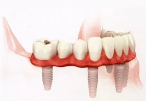 permanent dentures