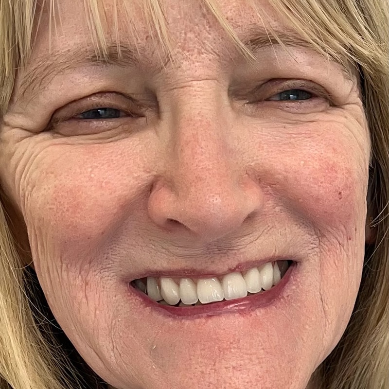 full lower and upper denture smile