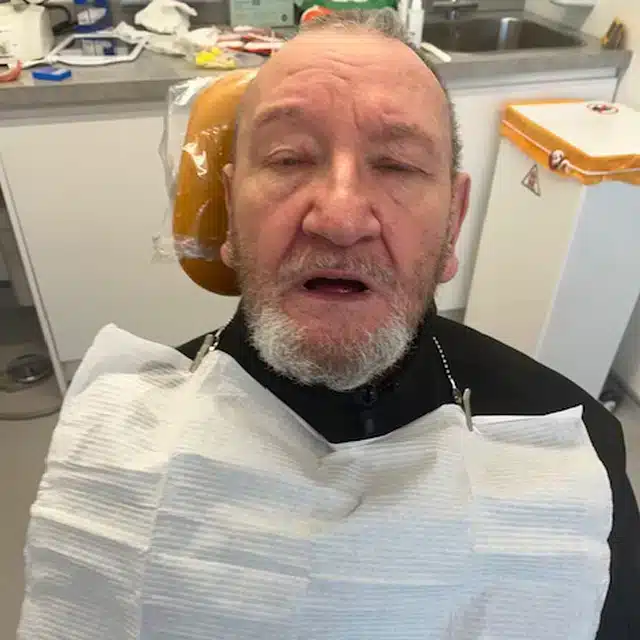 Louis-before-complete-upper-and-lower-dentures Louis-before-complete-upper-and-lower-dentures