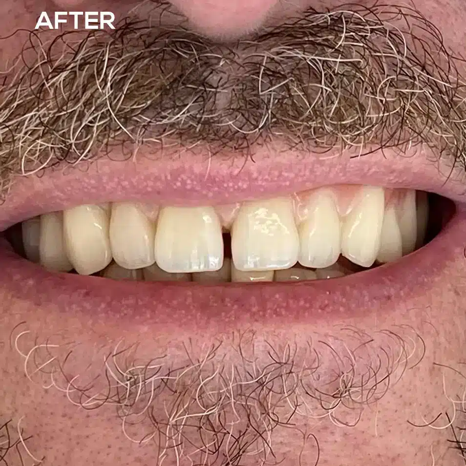 New Dentures After 1