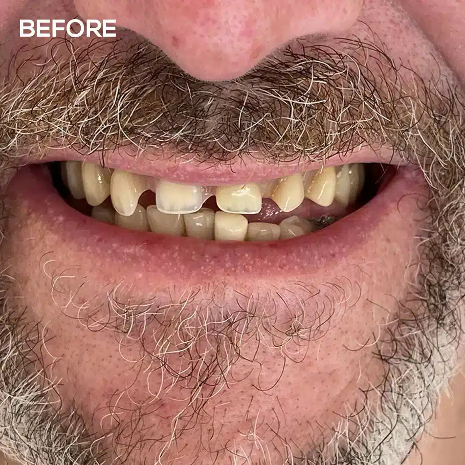 New Dentures Before 1