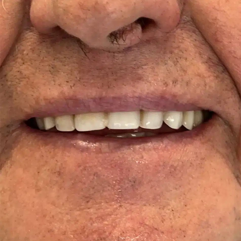 Premium-quality-dentures-before-1 Premium-quality-dentures-before-1