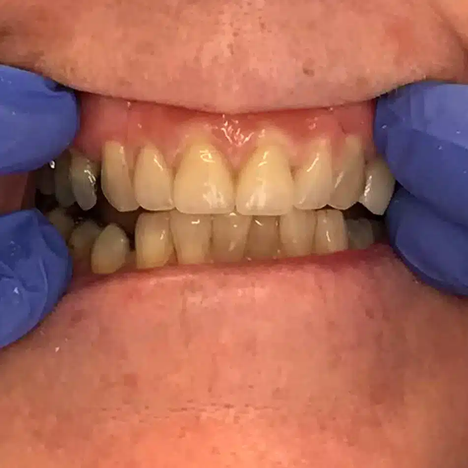 chrome-plate-dentures-after-1