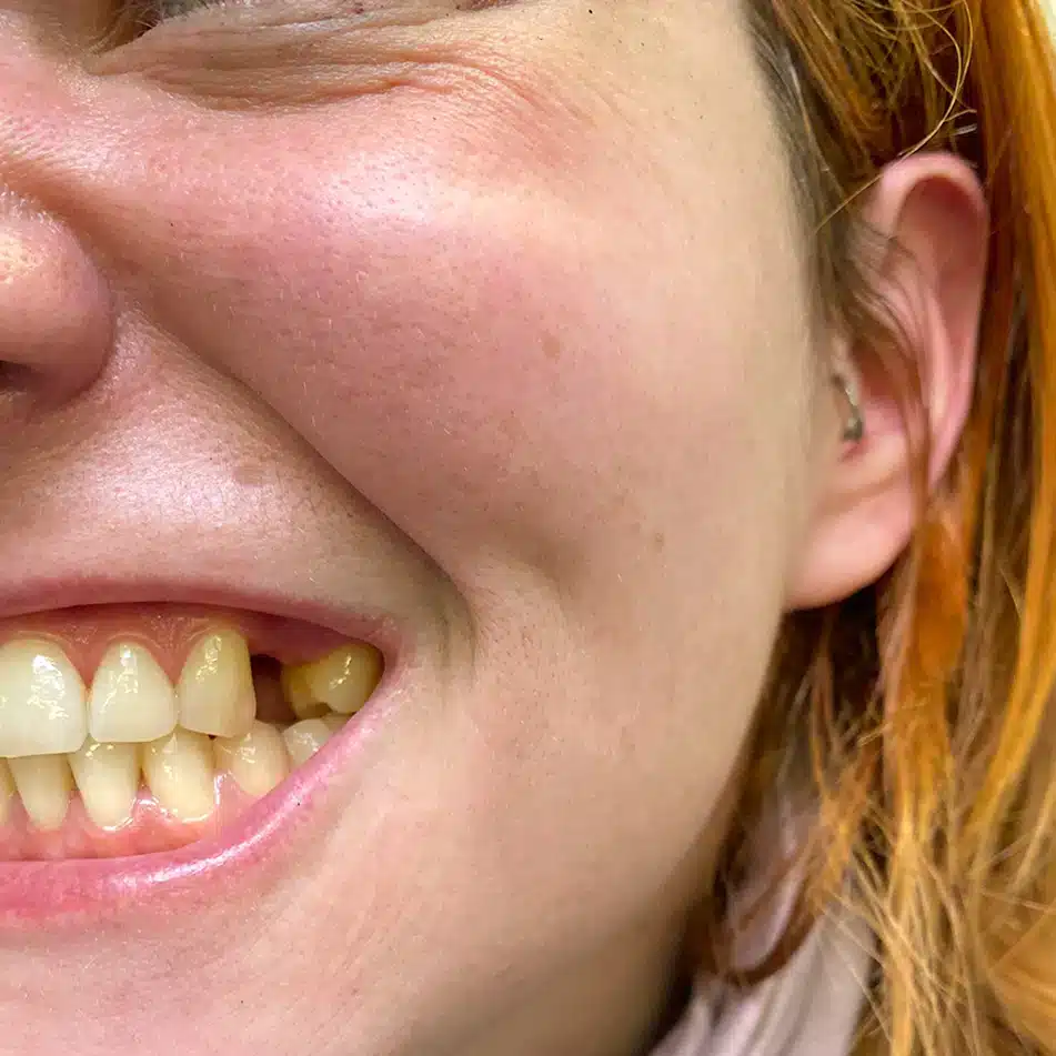 flexible-denture-before-1