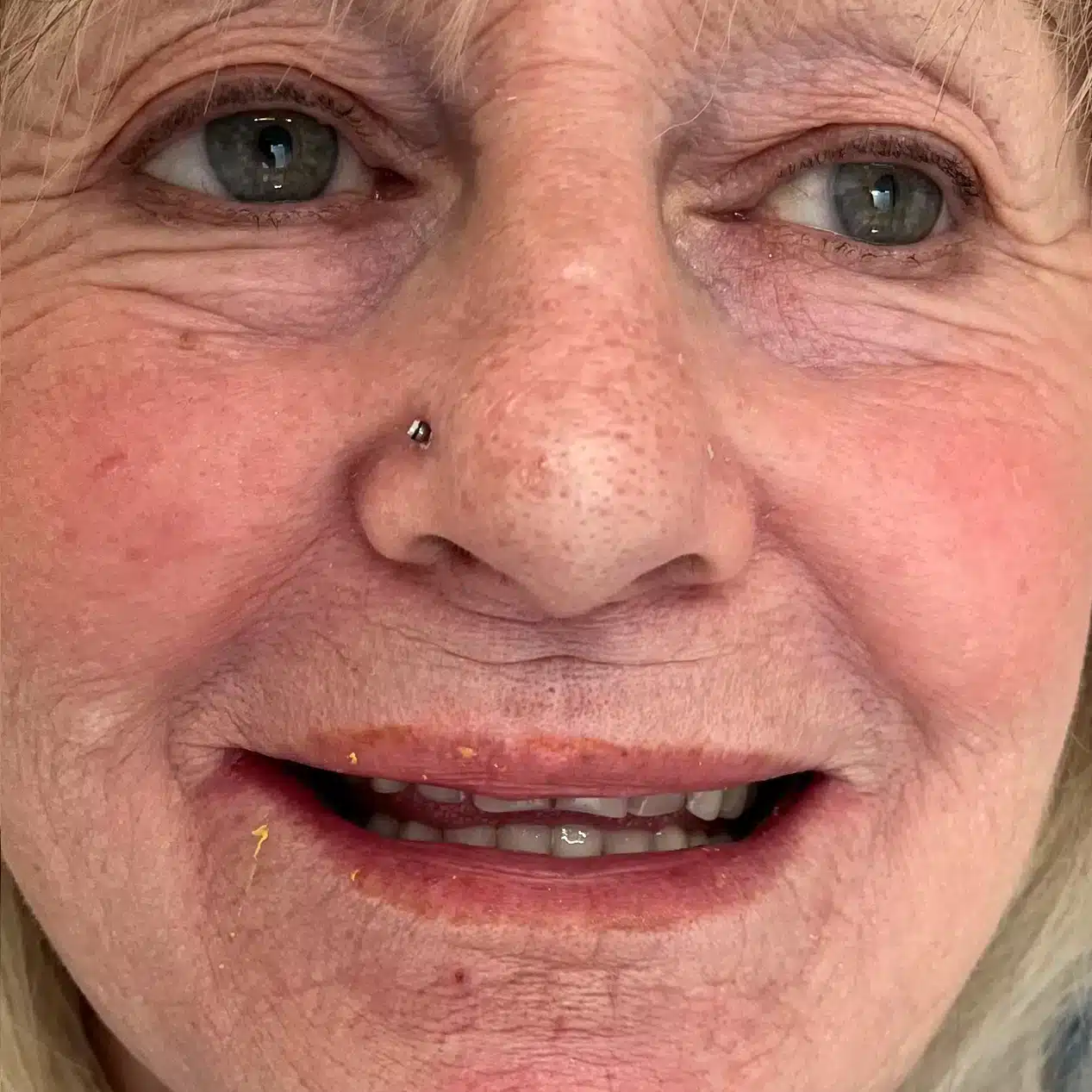 full-denture-smile-makeover-Before full-denture-smile-makeover-Before