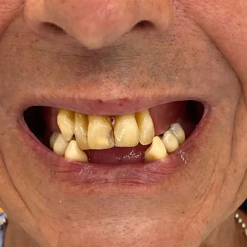 immediate-dentures-before-1 immediate-dentures-before-1