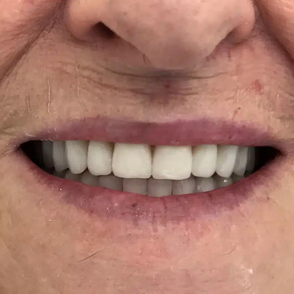 new-dentures-after-1