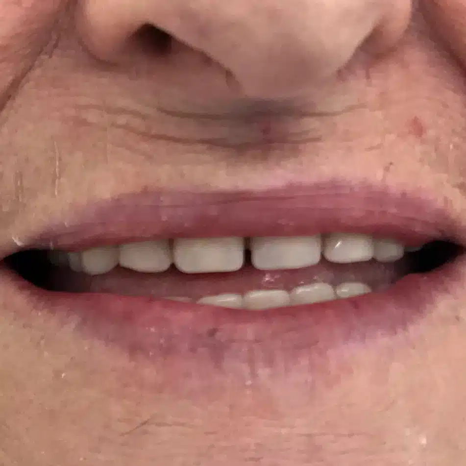 new-dentures-before-1 new-dentures-before-1