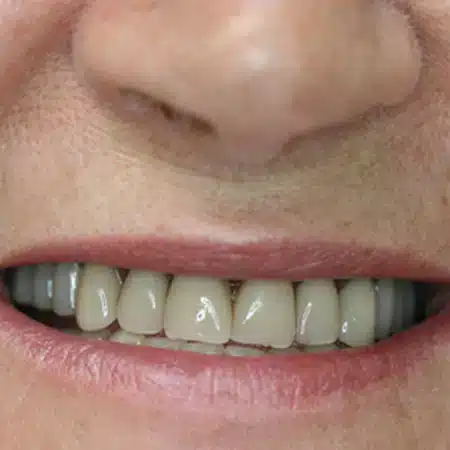 replacement-denture-repair-before replacement-denture-repair-before